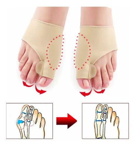 ToeAlign™ Orthopedic Corrector 6.0 (1 Pair) – Professional Bunion Relief & Toe Realignment Solution